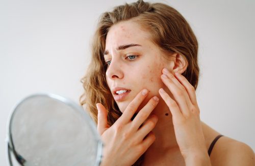 A woman looking in a mirror, touching her face, which is breaking out